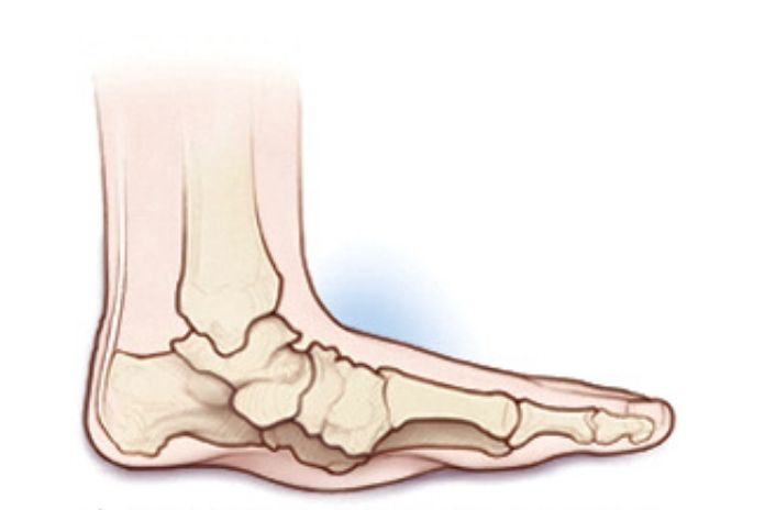 Charcot Disease: Age, First Symptoms, Life Expectancy