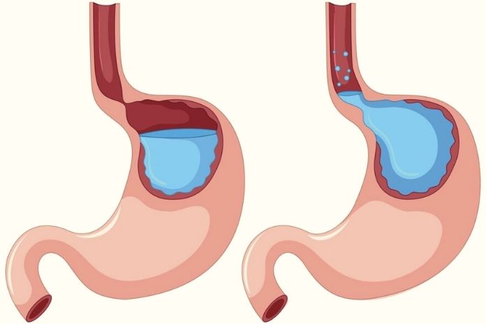 gastric-reflux-disease-gerd-causes-and-treatments