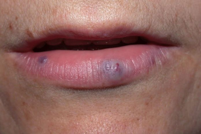 Purple Spot On The Lip What Can Be The Cause 